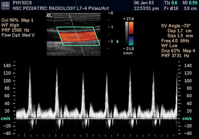 Doppler ultrasound